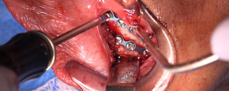 open-reduction-and-internal-fixation-of-mandibular-body-and-parasymphyseal-fractures-with-maxillomandibular-fixation-and-broken-tooth-extraction