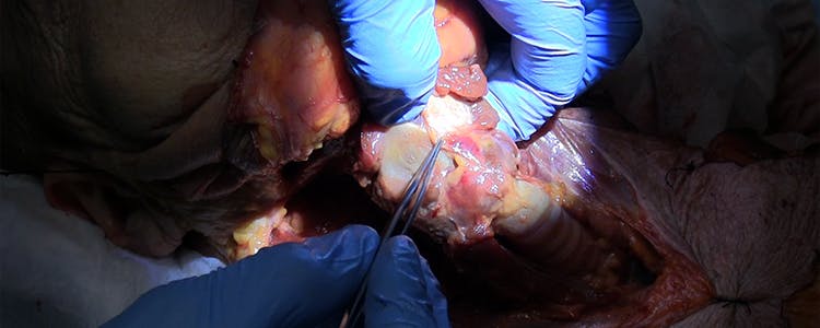 Partial-Laryngectomy-Techniques-(Cadaver)