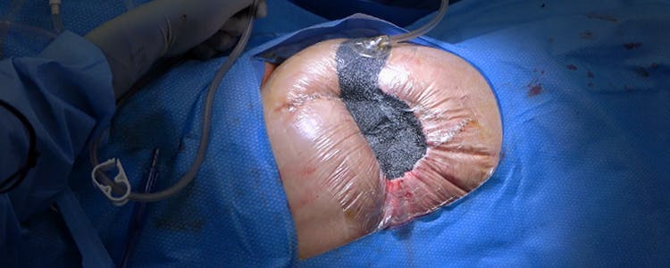 vacuum-assisted-closure-(vac)-change-for-a-complex-right-hip-wound