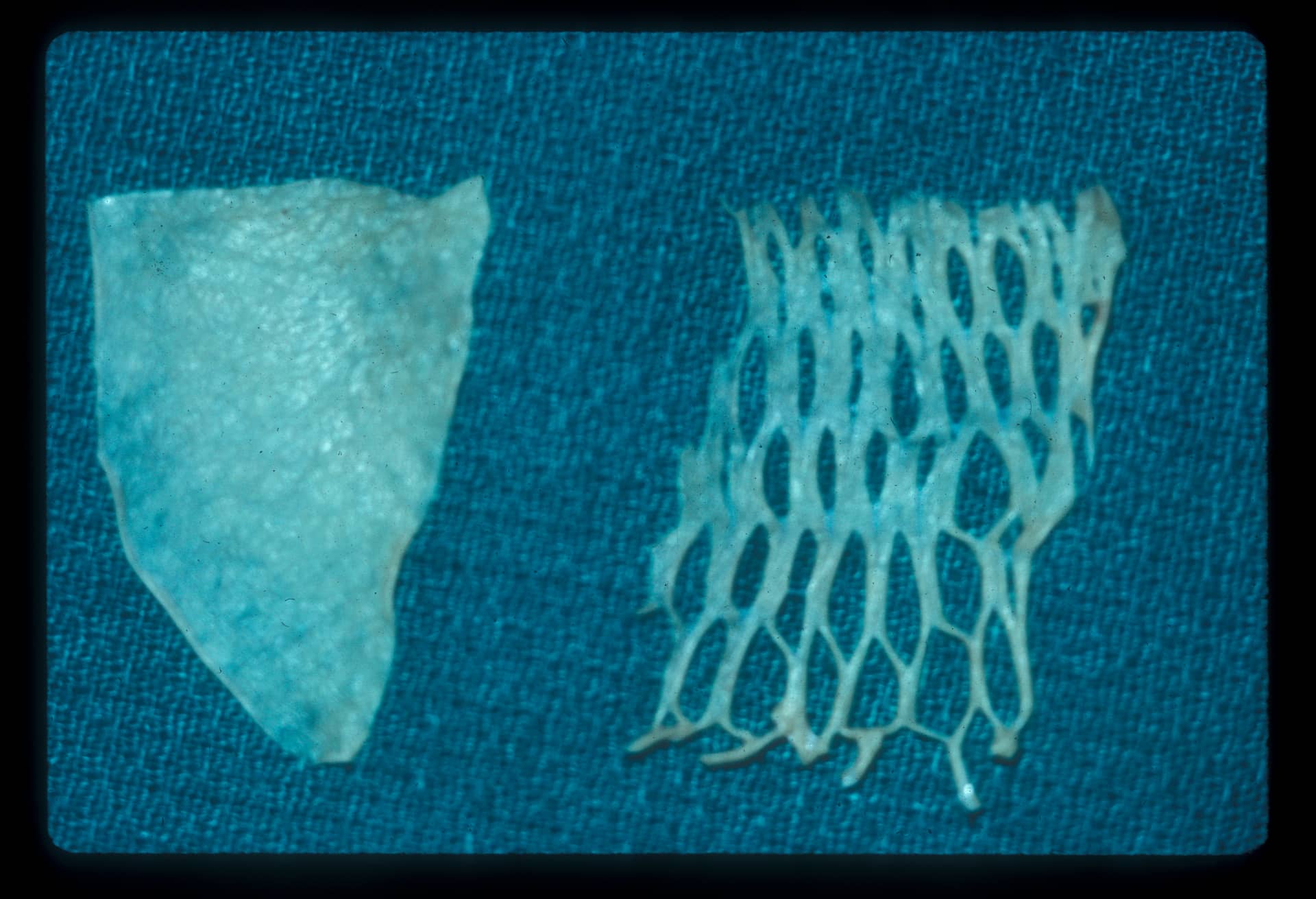 Squamous Cell Carcinoma Excision from Right Forearm with Split