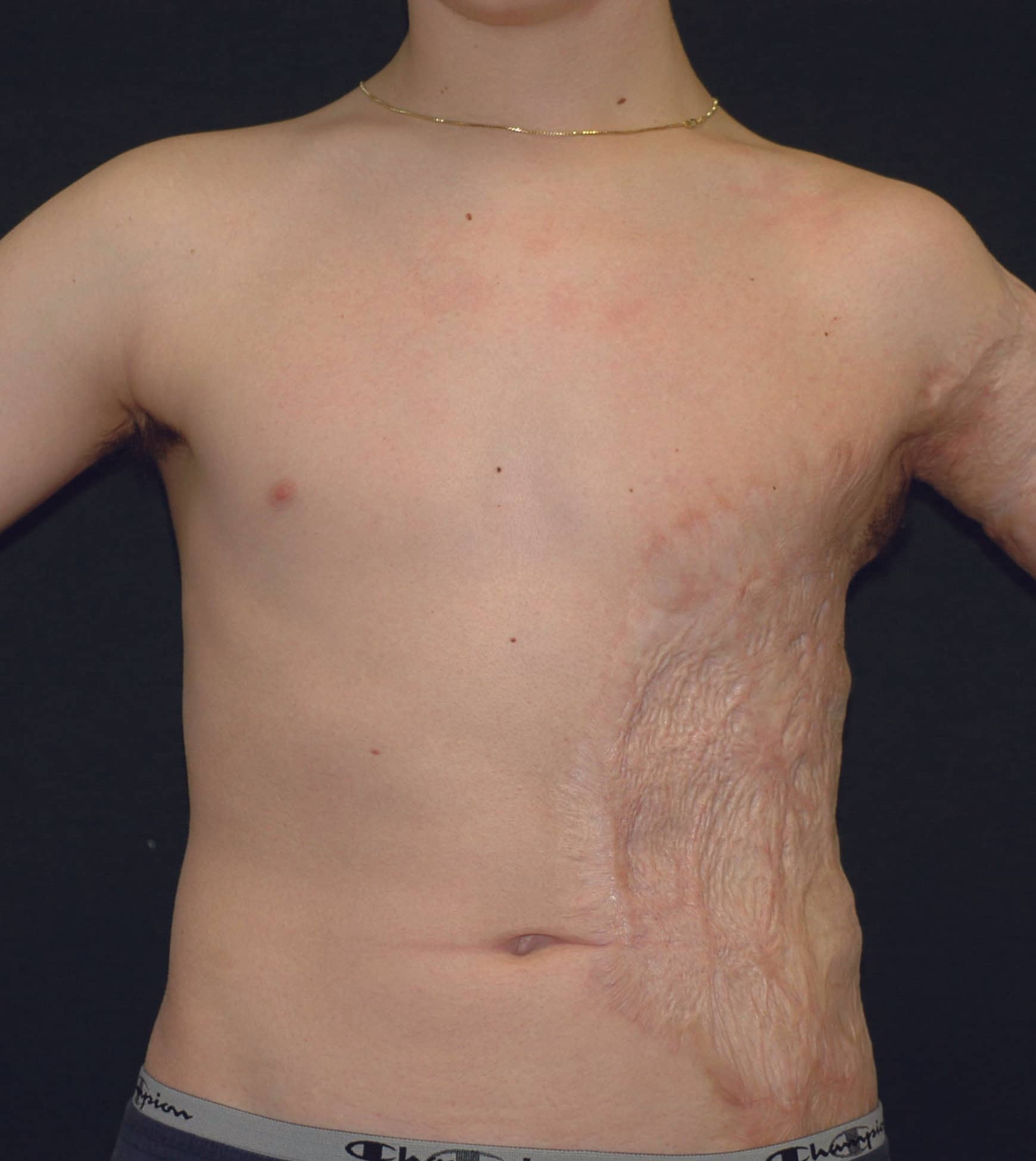 Squamous Cell Carcinoma Excision from Right Forearm with Split