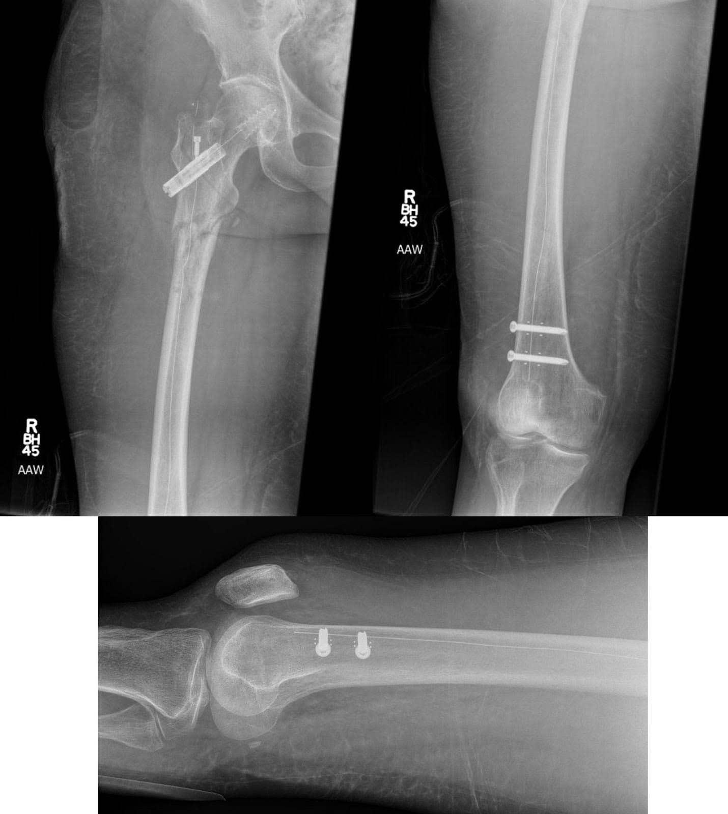 Carbon Fiber Implant for Fixation of a Pathologic Subtrochanteric ...