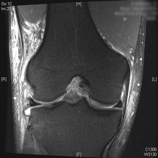 ACL MRI COronal 2