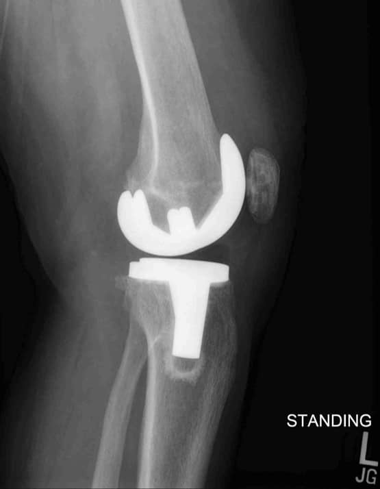 Slope Knee Lift