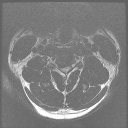 Axial T2 C3C4