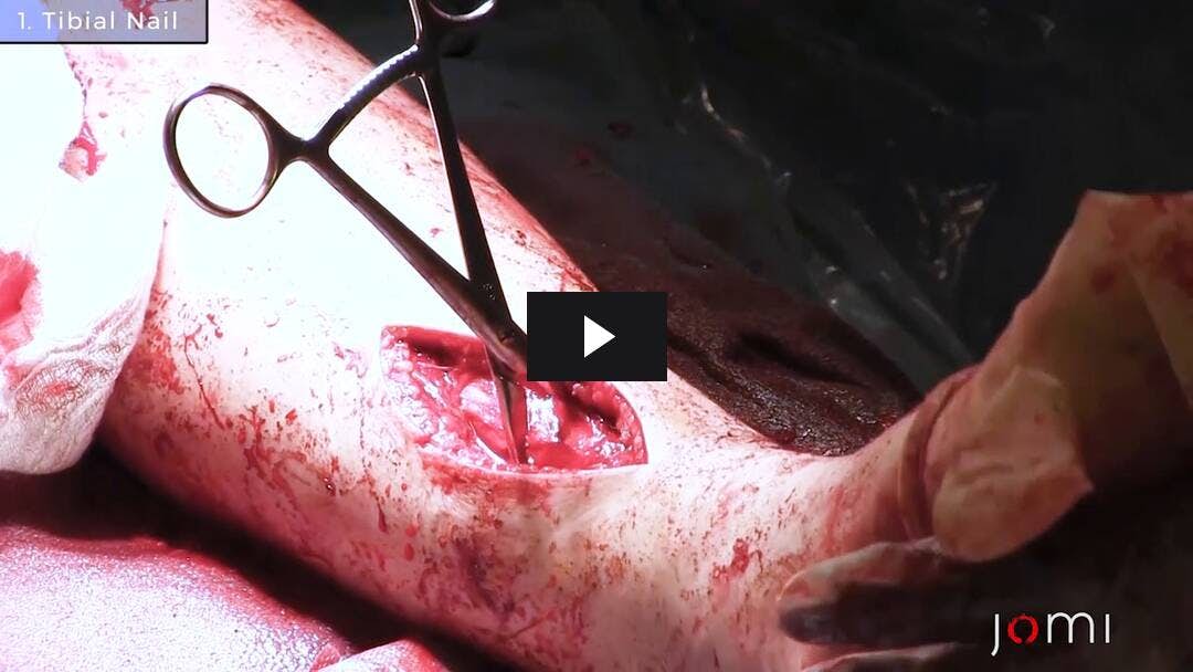 Video preload image for Uña intramedular para fractura tibial abierta