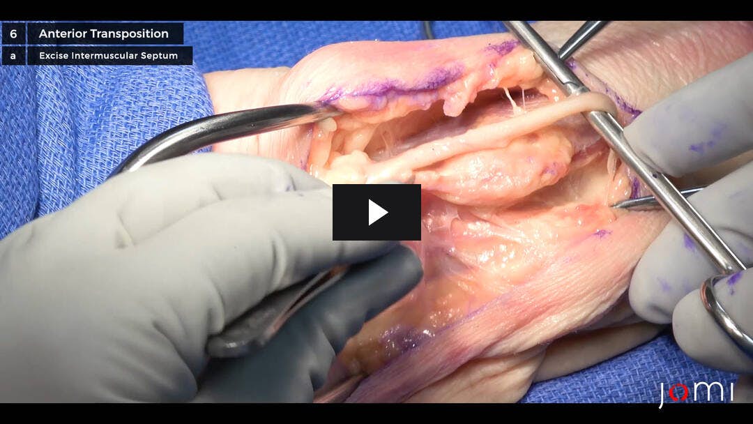 Video preload image for Transposición del nervio cubital (cadáver)
