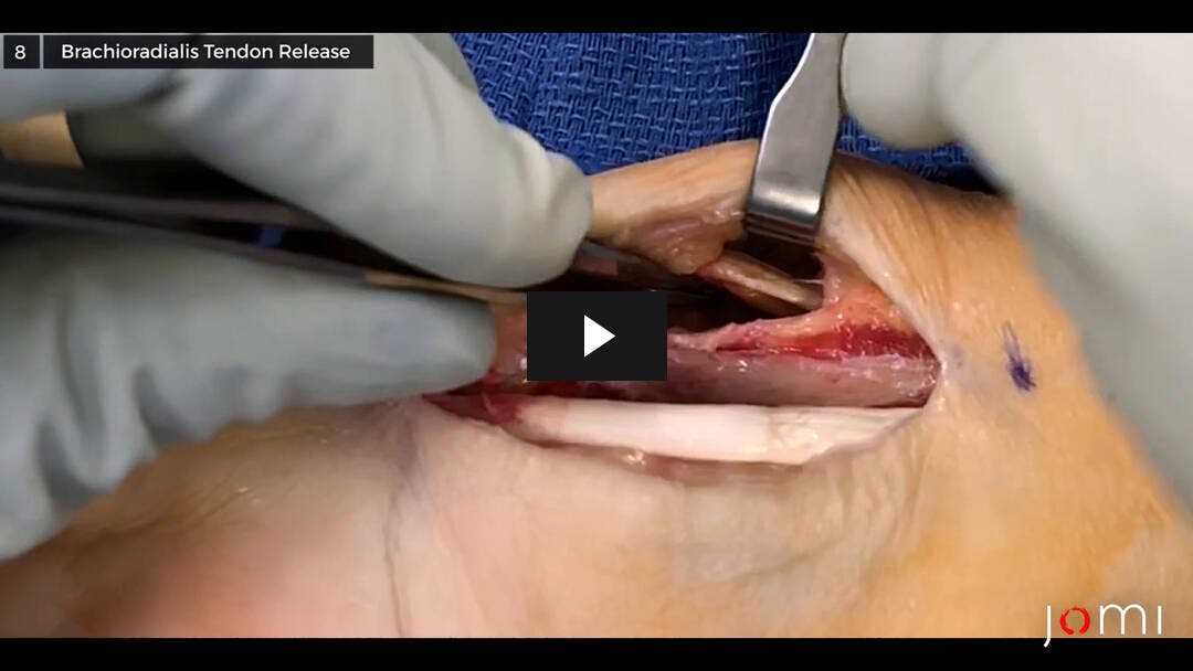 Video preload image for Distal Radius Open Reduction and Internal Fixation