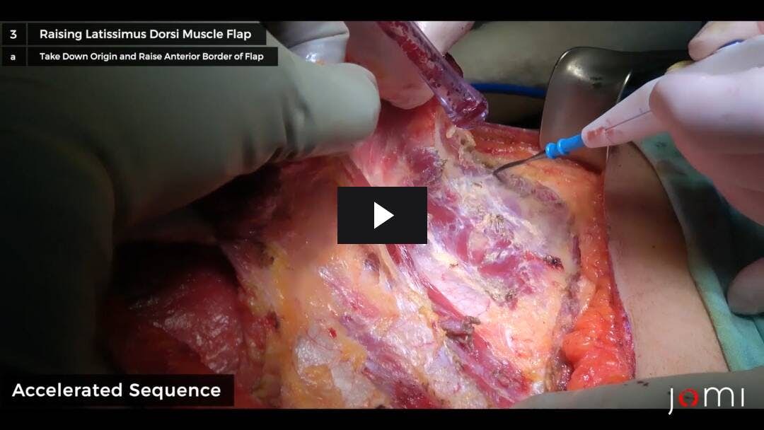 Video preload image for Der vielseitige Musculus latissimus dorsi als lokaler Lappen zur Abdeckung der Brustwand