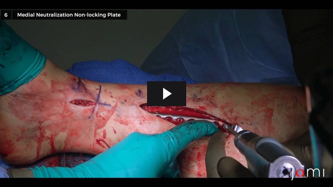 Video preload image for Right Distal Tibial Oblique Fracture Open Reduction and Internal Fixation (ORIF) with Medial Neutralization Non-locking Plate