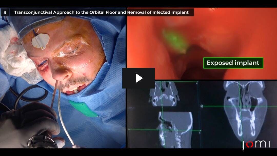 Video preload image for Neuronavigation and Endoscopy as Adjunctive Tools in Orbital Floor Implant Revision: Surgical Management of Infected, Misplaced Orbital Floor Implant with Chronic Eyelid Fistula and Sinusitis