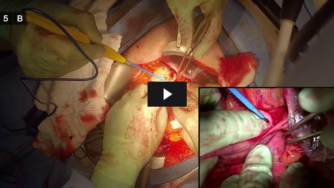 Video preload image for Whipple Procedure for Carcinoma of the Pancreas - Part 1