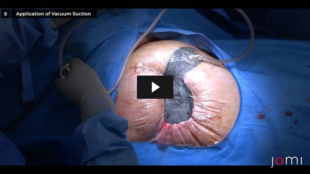 Video preload image for Vacuum-Assisted Closure (VAC) Change for a Complex Right Hip Wound