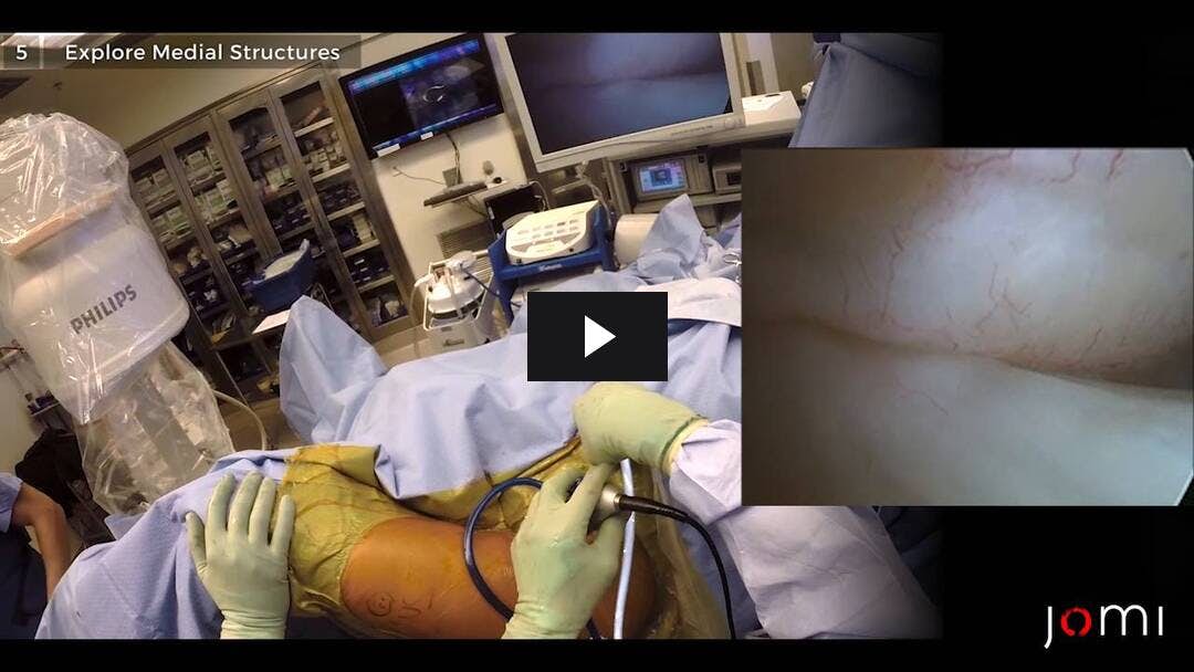 Video preload image for Diagnostic Hip Arthroscopy