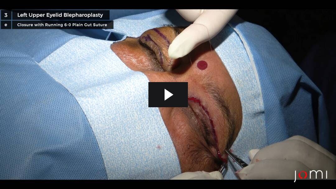 Video preload image for Blepharoplasty for Bilateral Upper Eyelids