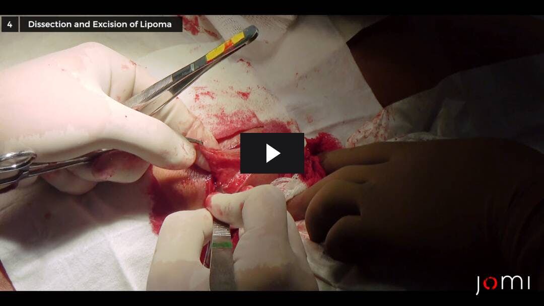 Video preload image for Lipoma Excision