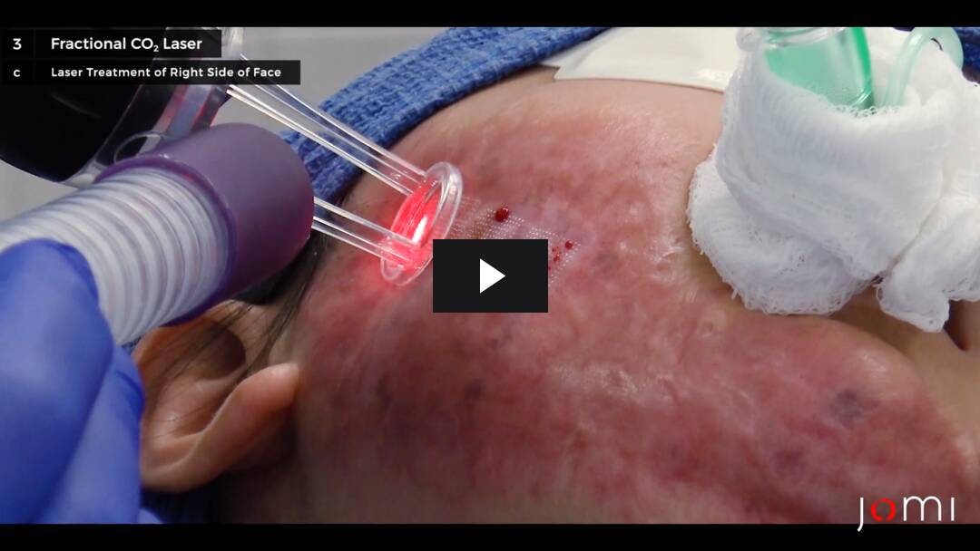 Video preload image for Gepulste Farbstoff- und fraktionierte CO2-Lasertherapie zur Behandlung von Brandnarben