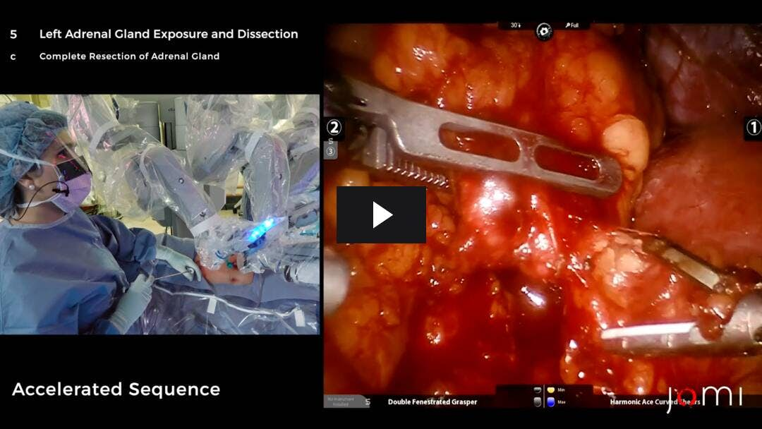 Video preload image for Robotic-Assisted Left Adrenalectomy