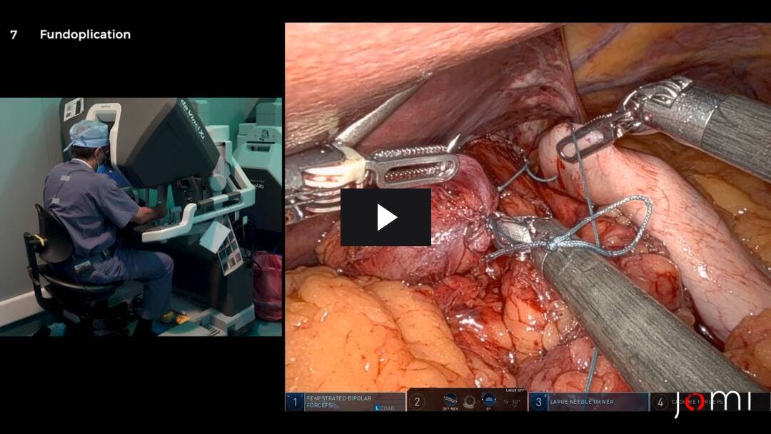 Video preload image for Robotergestützte laparoskopische paraösophageale Hiatushernie-Reparatur mit Fundoplikatiat und Ösophagogastroduodenoskopie