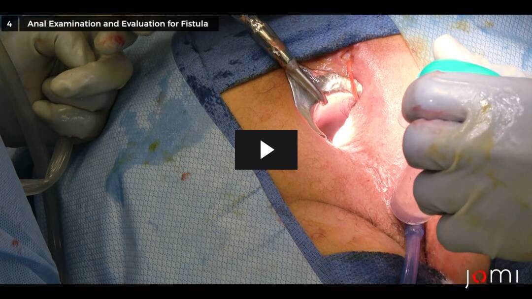 Video preload image for Examen anal bajo anestesia con drenaje de abscesos y evaluación de fístulas