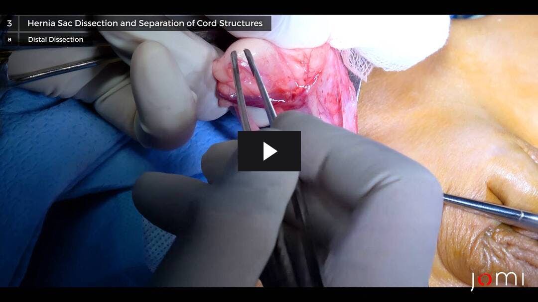 Video preload image for Reparación de hernia inguinal abierta derecha del bebé