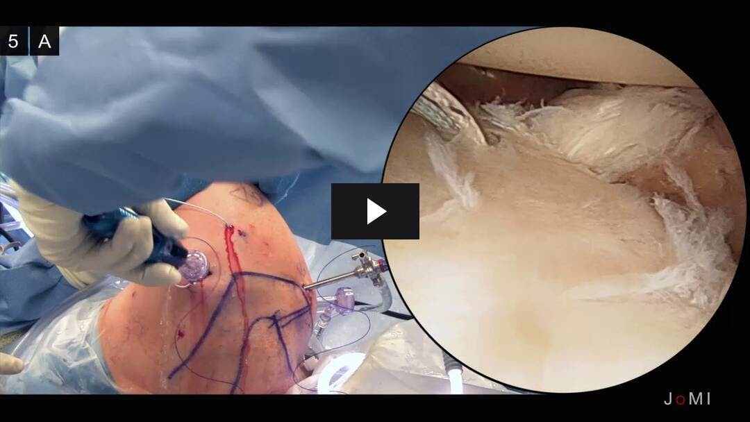 Video preload image for Reparación artroscópica de Bankart para la inestabilidad anterior del hombro utilizando un portal posterolateral