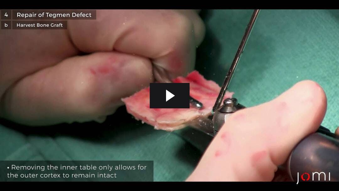 Video preload image for Middle Fossa Approach to Repair Cerebrospinal Fluid Leak