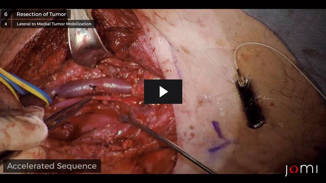 Video preload image for Disección bilateral de cuello radical modificado