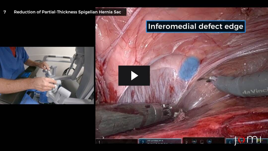 Video preload image for Robotic-Assisted Repair of a Left Lower Quadrant Spigelian-Type Hernia