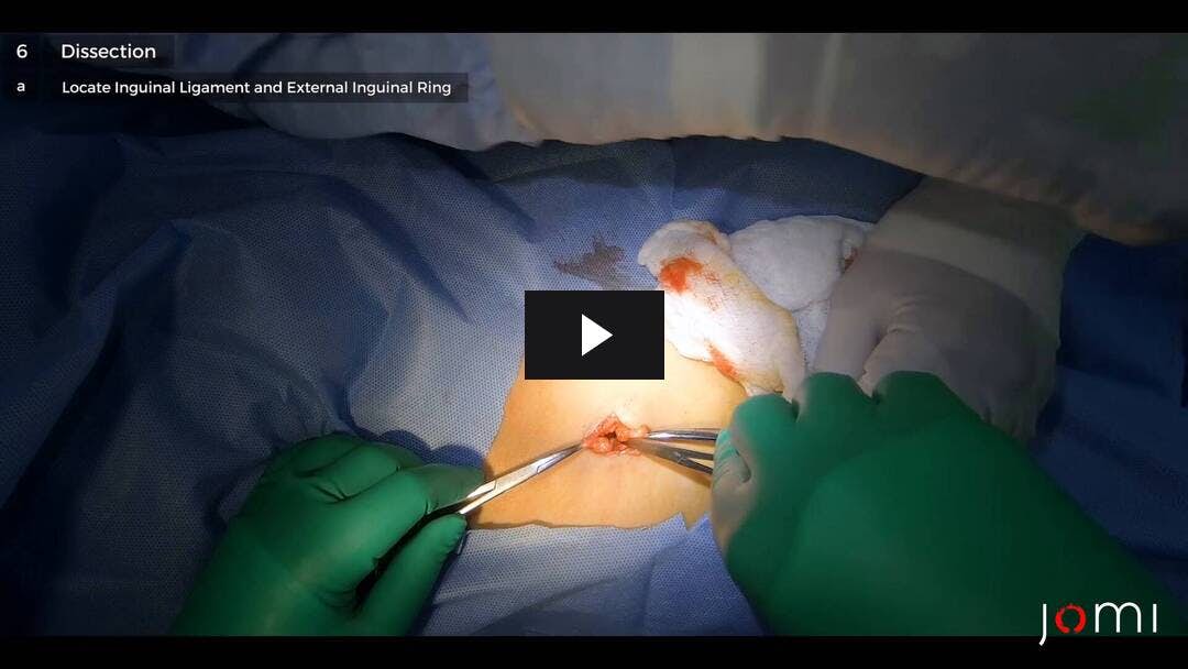 Video preload image for Herniotomía inguinal indirecta bilateral pediátrica