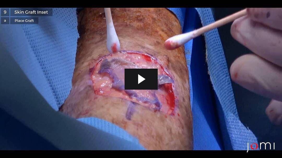 Video preload image for स्क्वैमस सेल कार्सिनोमा जांघ से स्प्लिट-मोटाई त्वचा ग्राफ्ट के साथ दाएं अग्रभाग से उच्छेदन