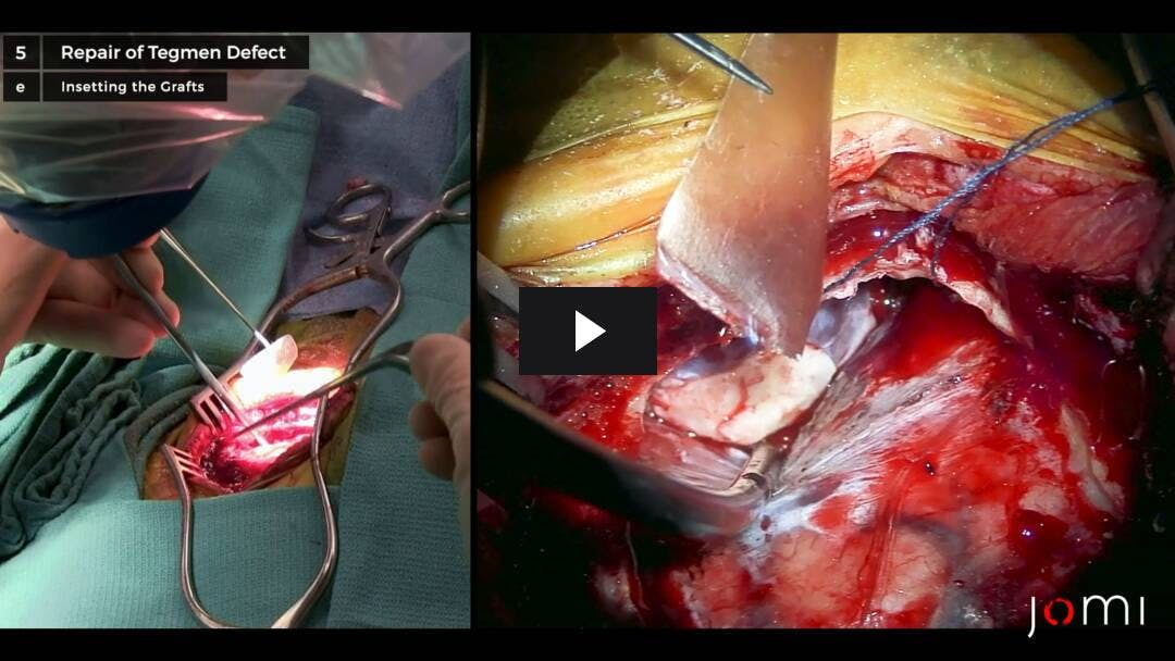 Video preload image for Middle Fossa Approach to Repair Cerebrospinal Fluid Leak