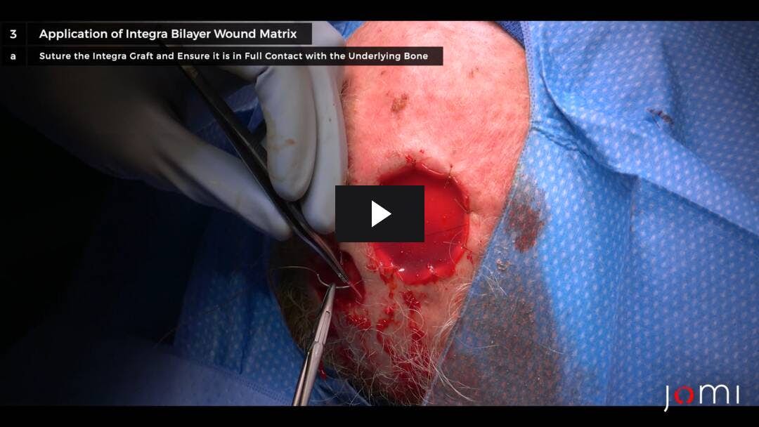 Video preload image for Integra Scalp Reconstruction: Addressing a Full-Thickness Scalp Defect with Exposed Calvarium Along Vertex in an Elderly Immunocompromised Patient