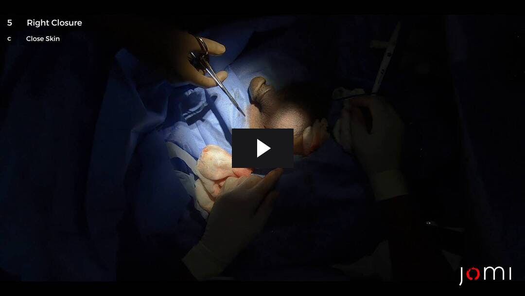 Video preload image for Bilaterale einfache Hydroklektomie und Entfernung von subdermalen Implantaten
