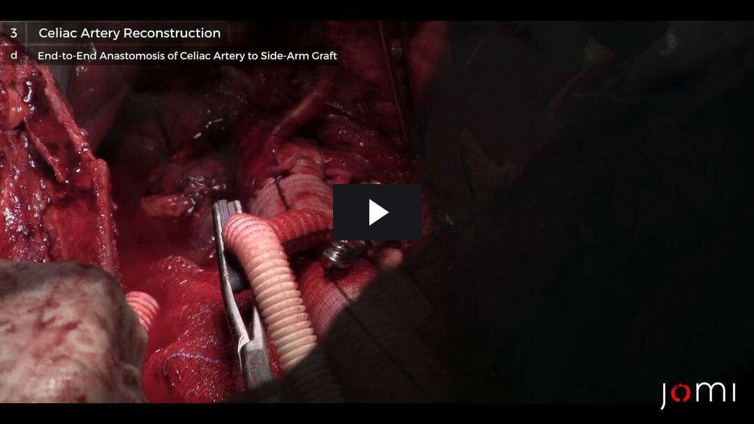 Video preload image for Thoracoabdominale Aortenaneurysma Reparatur - Teil 2