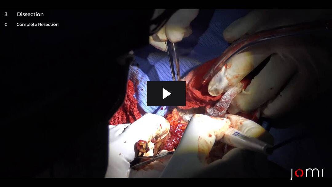 Video preload image for Feinnadelaspirationsbiopsie und Exzisionsbiopsie einer zystischen Masse in der rechten Brust (männlich)
