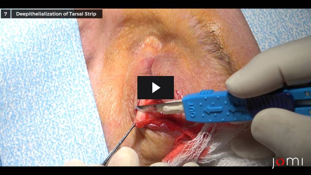 Video preload image for Lateral Tarsal Strip Procedure for Left Lower Eyelid Entropion
