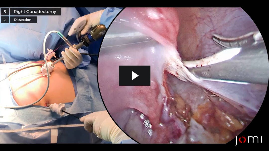 Video preload image for Gonadectomía bilateral laparoscópica profiláctica para el síndrome de insensibilidad completa a los andrógenos