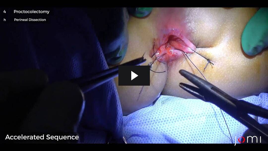 Video preload image for Open Proctocolectomy for Hirschsprung's Disease