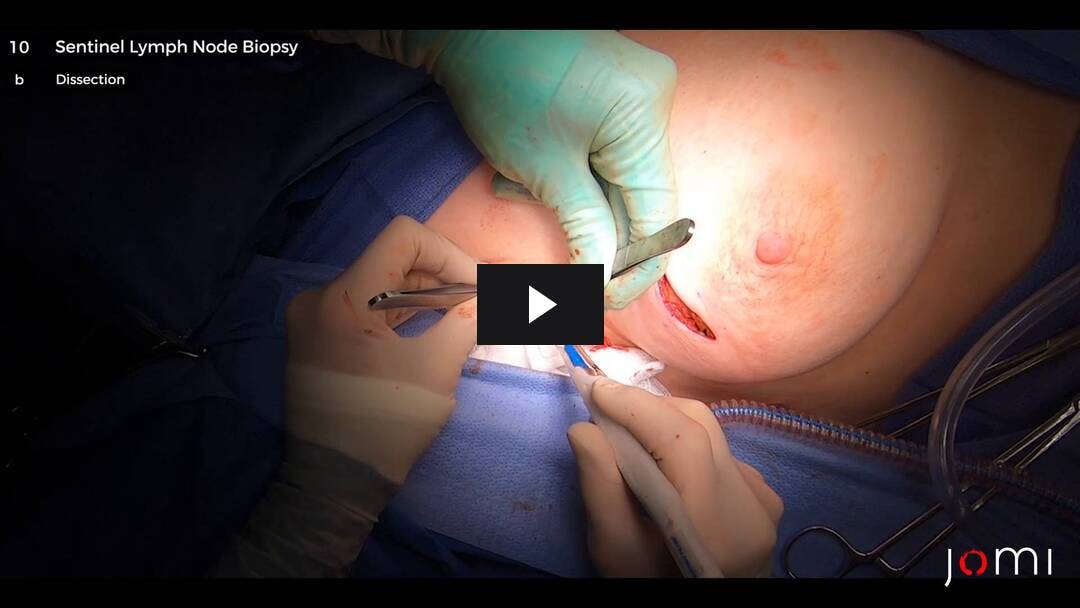 Video preload image for Lumpectomía y biopsia de ganglio linfático centinela con sistema Lumicell para la detección intraoperatoria de cáncer residual