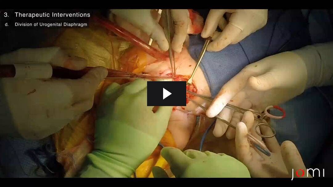 Video preload image for Reparación de extrofia cloacal