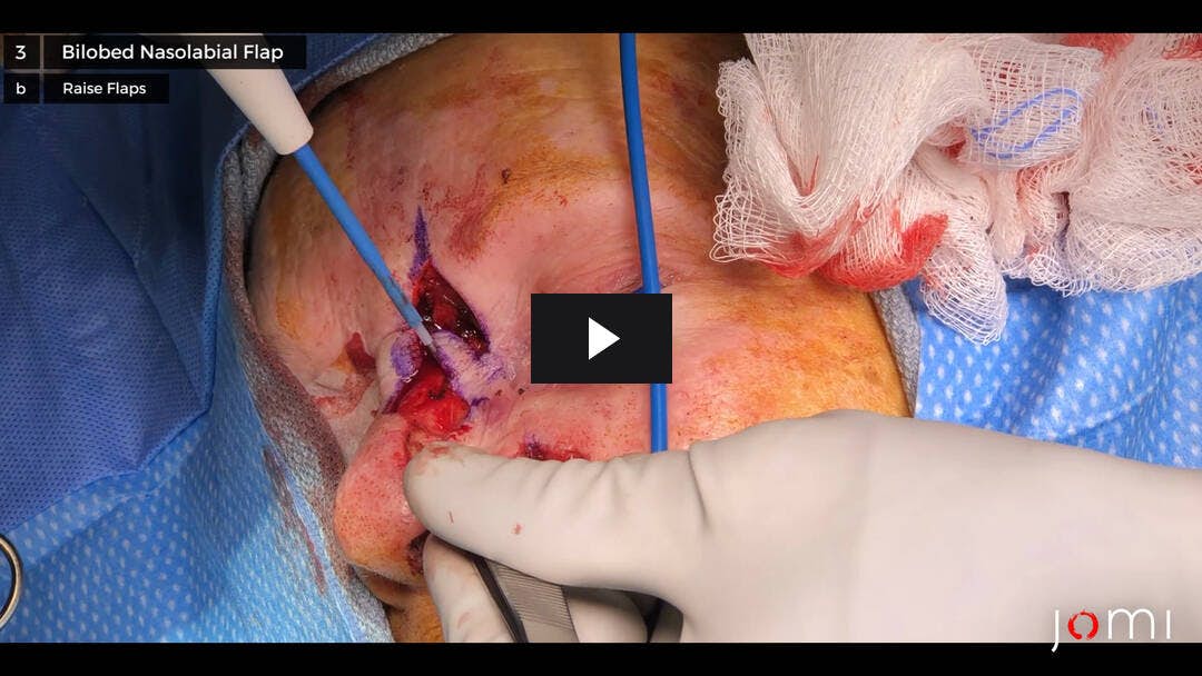 Video preload image for Reconstrucción de un defecto cutáneo nasal grande con colgajos nasolabiales y romboidales