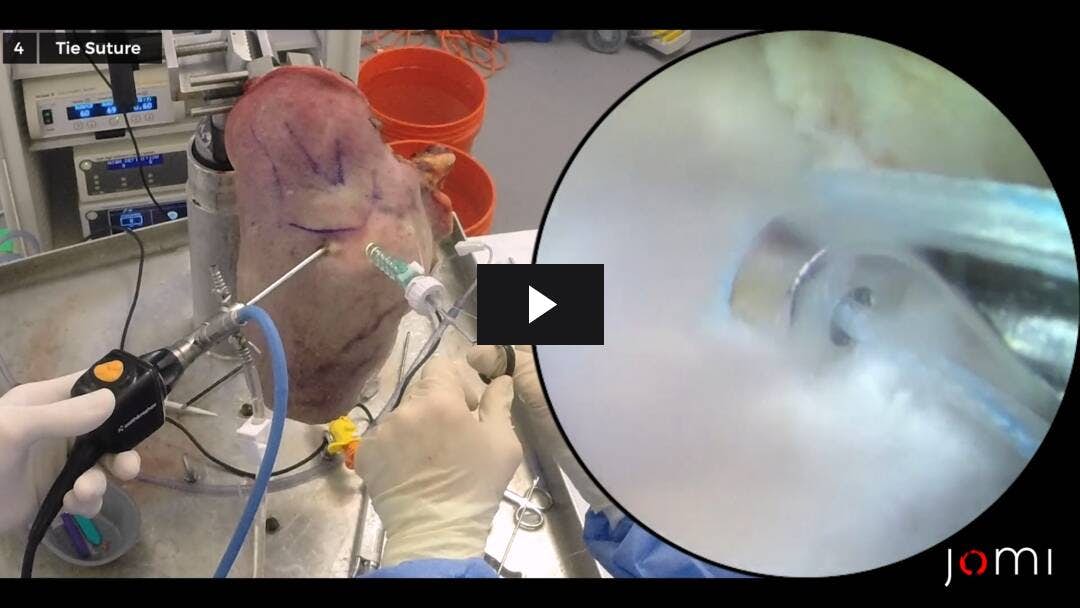 Video preload image for Reparación del manguito rotador (hombro cadáver)