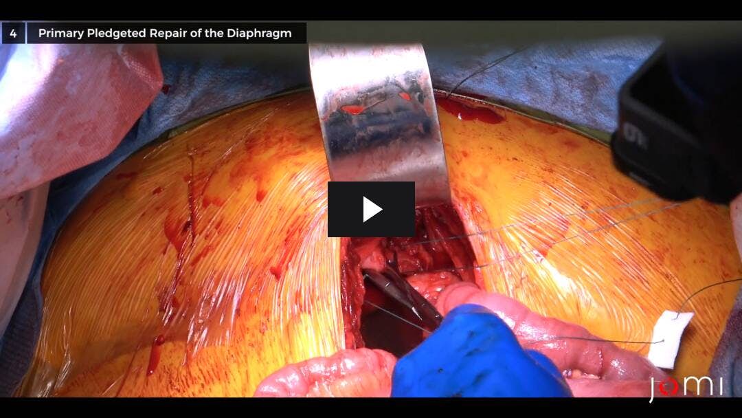 Video preload image for Exploratory Laparotomy for Bowel Obstruction with Primary Repair of Two Diaphragmatic Hernias