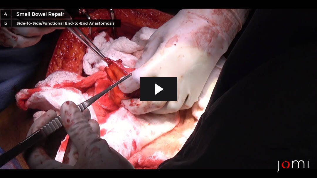 Video preload image for Exploratory Laparotomy in a Hemodynamically Stable Patient for an Abdominal Gunshot Wound