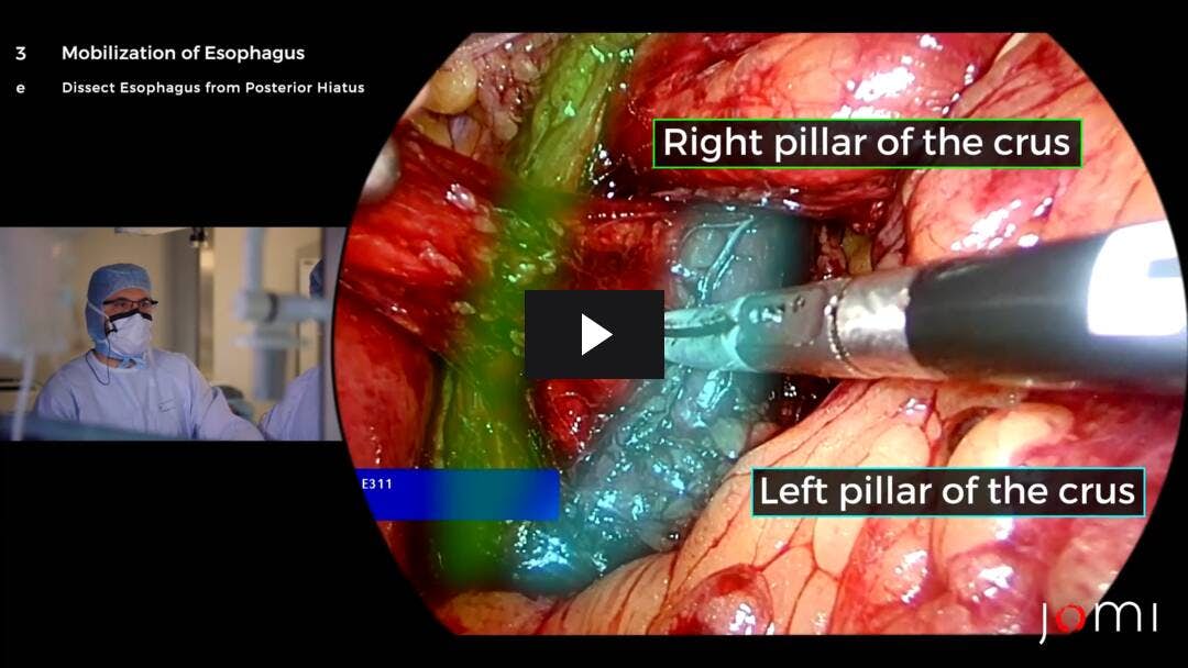 Video preload image for Fundoplication di Nissen laparoscopica