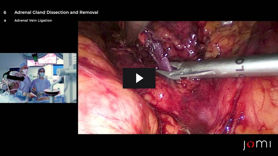 Video preload image for Adrenalectomía transperitoneal laparoscópica izquierda para el aldosteronoma