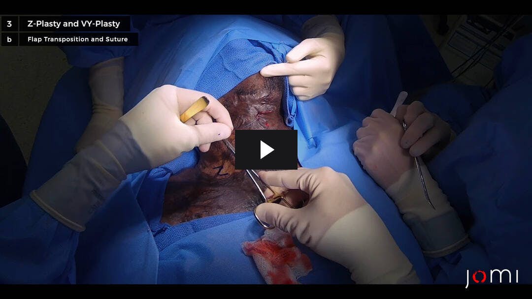 Video preload image for Local Tissue Rearrangement for Hypertrophic Chemical Burn: Z-Plasty and VY-Plasty
