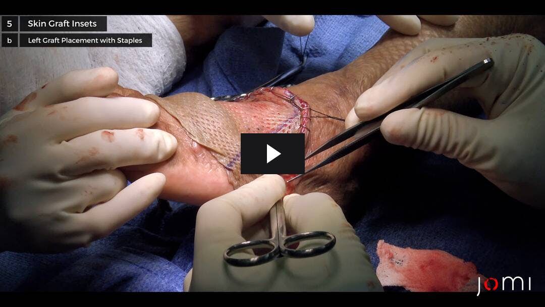 Video preload image for Bilaterale dorsale Fußnarbenkontrakturfreisetzung mit Split-Dicken-Hauttransplantaten aus dem vorderen Oberschenkel
