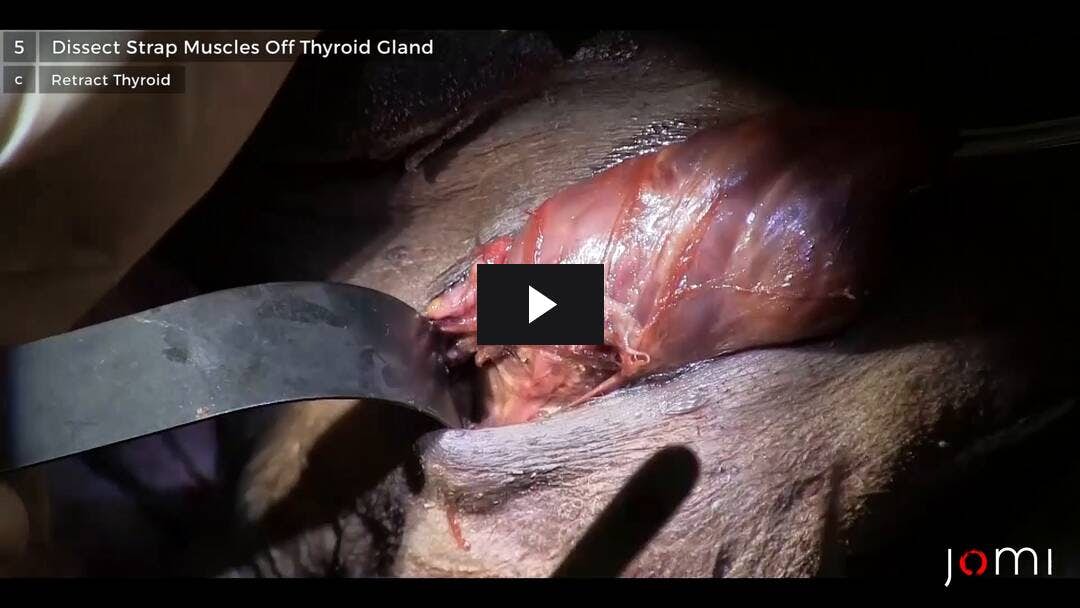 Video preload image for Thyroidectomy (Cadaver)